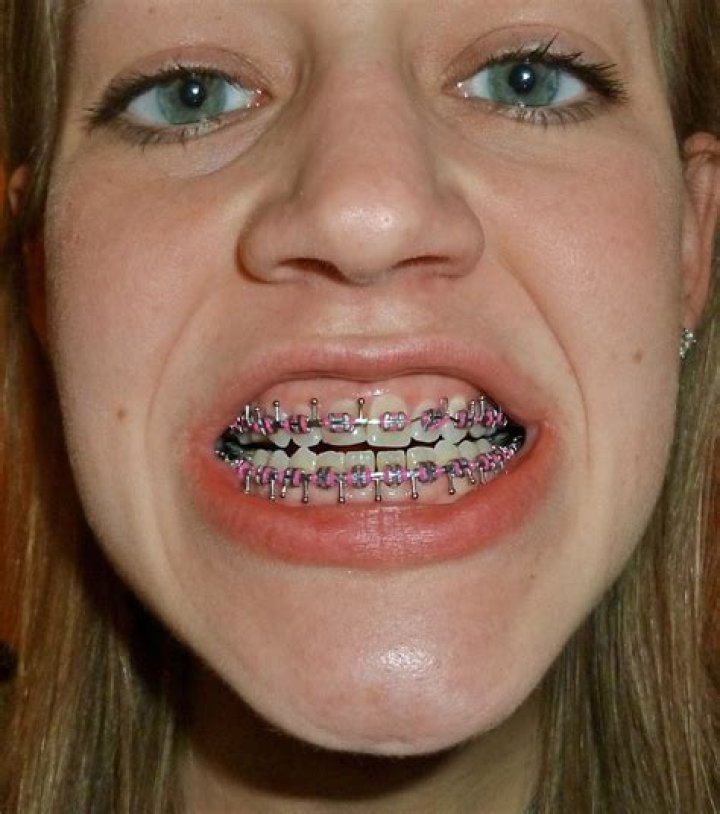 Braces That Look Like Grills: A Unique Fashion Statement